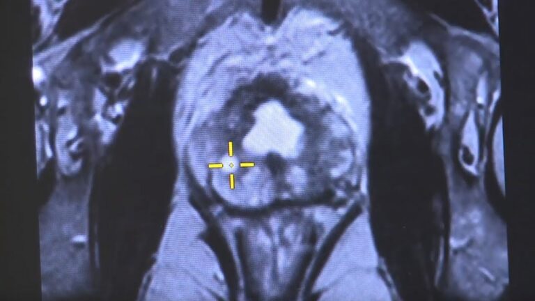 Biopsia prostatica fusion: scopri dove effettuarla per una diagnosi precisa
