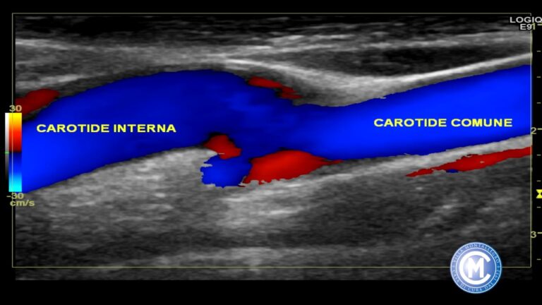 Ecocolordoppler: sintomi e diagnosi ottimizzate con la TSA