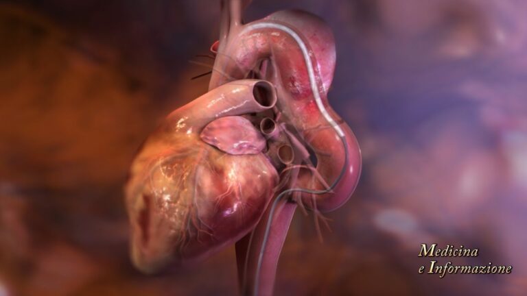 Protesi aorta addominale: la soluzione innovativa per una durata senza precedenti