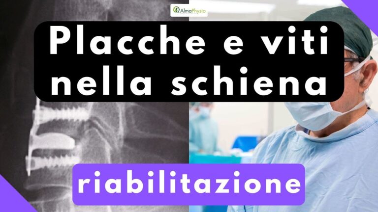 Stabilizzazione vertebrale: l'efficacia delle viti e delle barre