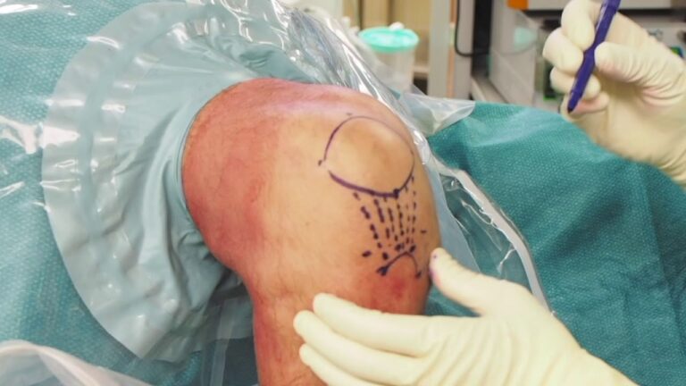 Pulizia del ginocchio: scopri i benefici dell'artroscopia!
