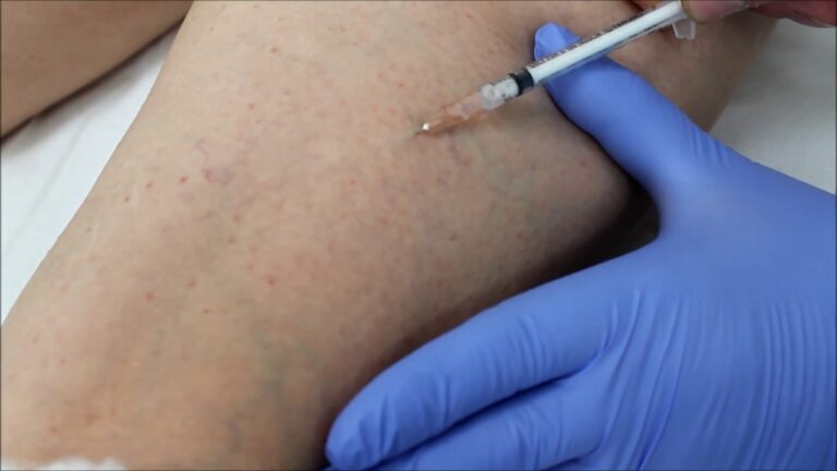 Risultati dello Sclerosante: Prima e Dopo