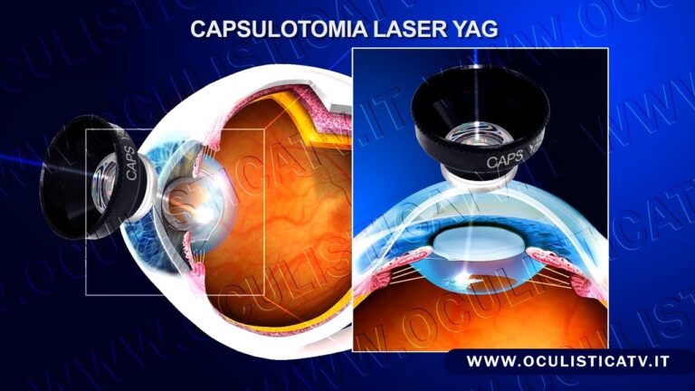 Cataratta secondaria: scopri in quanti anni si sviluppa e come prevenirla