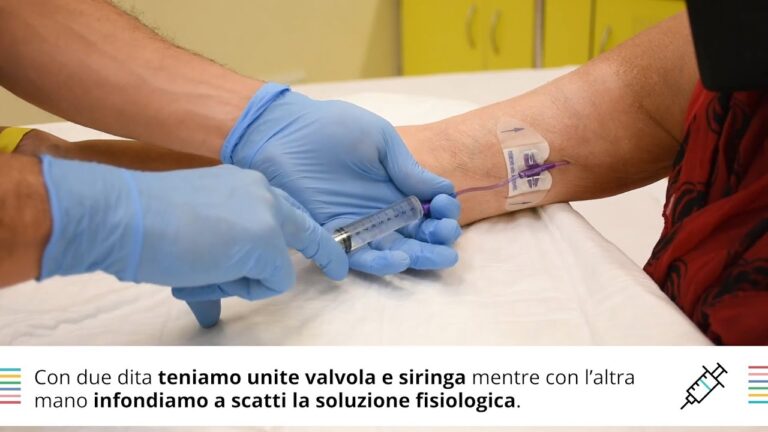 Lavaggio picc con soluzione fisiologica: il metodo rivoluzionario per igiene impeccabile!