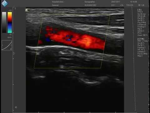 Placca Carotidea di 2 mm: Implicazioni e Trattamenti Ottimizzati