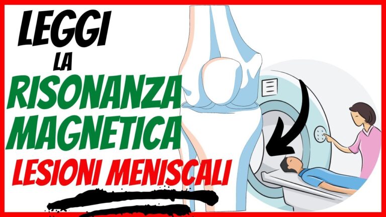 Valutazione ottimizzata della lesione al menisco tramite risonanza magnetica