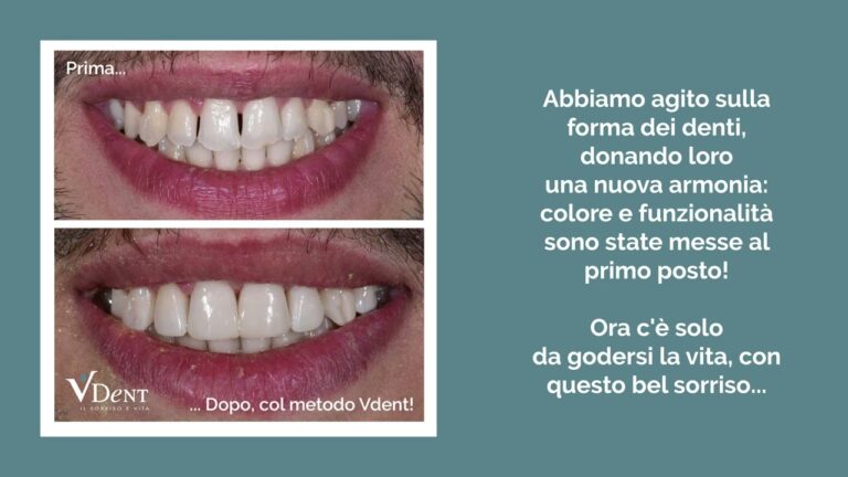 Risultati impressionanti: Otturazione prima e dopo