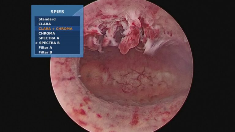Ispessimento endometrio in menopausa: Senza sanguinamento