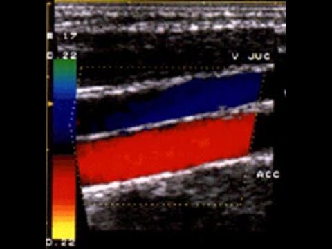 Valori Normali dell'Ecocolordoppler TSA: Un'Analisi Ottimizzata e Concisa
