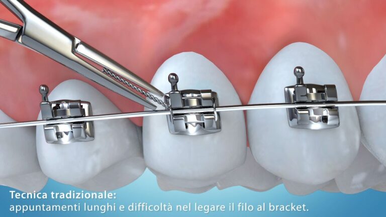 Allineamento denti: Il segreto per un sorriso perfetto