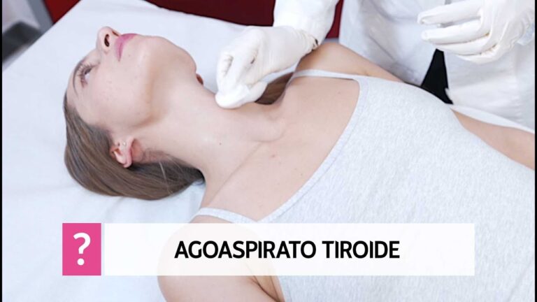 Testimonianze sull'agoaspirato tiroideo: una guida ottimizzata