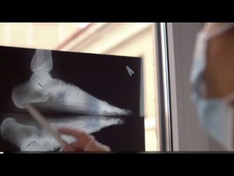 Frattura dei talloni: diagnosi, trattamento e recupero efficace