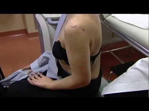 Infiltrazioni di acido ialuronico per la spalla: un trattamento efficace