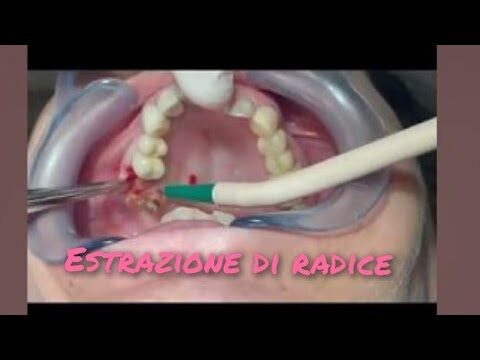 Efficiente estrazione della radice del dente devitalizzato