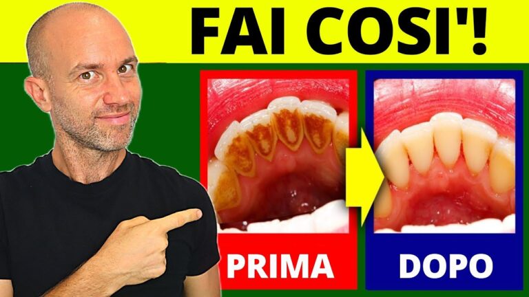 Eliminare la carie con il bicarbonato: il rimedio naturale efficace