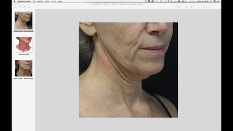 Botox: Prima e dopo - I risultati sorprendenti