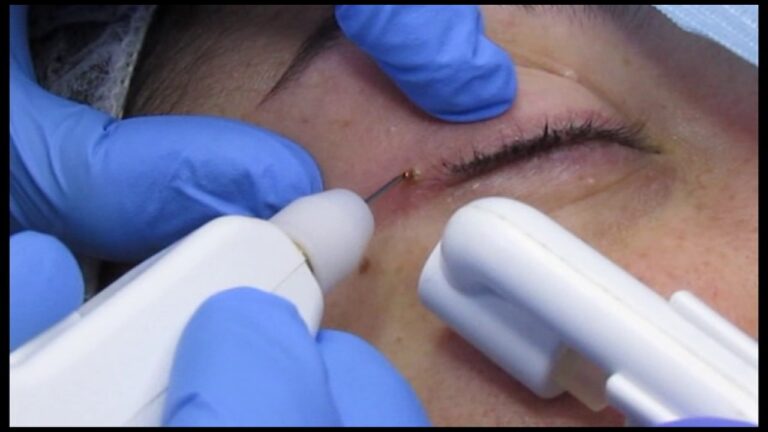 Il metodo di curettage dermatologico: un trattamento efficace contro le lesioni cutanee