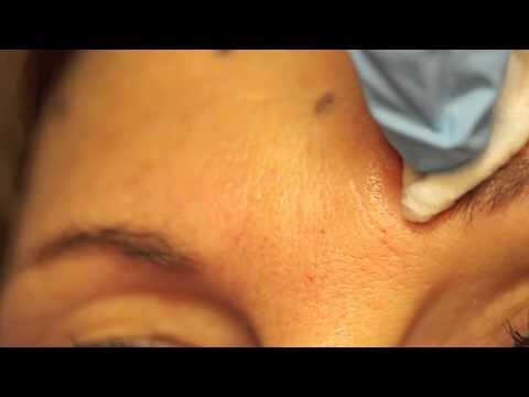 Botox per le Zampe di Gallina: Prima e Dopo