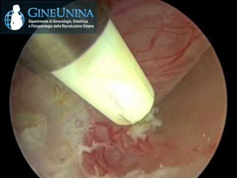 Guida alla Polipectomia dell'Utero: Procedure Ottimizzate