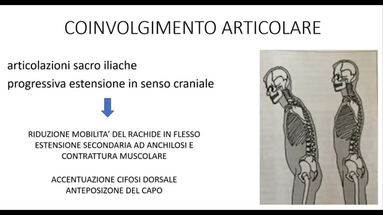 Come affrontare la spondilite anchilosante: consigli per camminare
