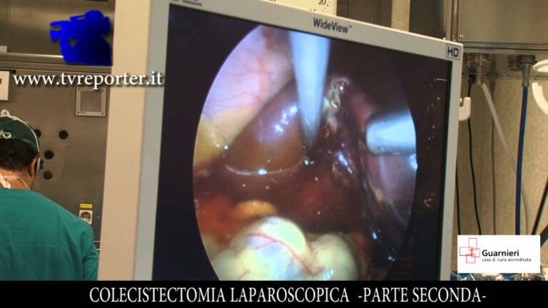 Riduzione delle cicatrici nella laparoscopia della colecisti