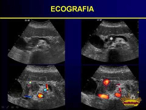 Ecografia pancreas: Cosa si visualizza