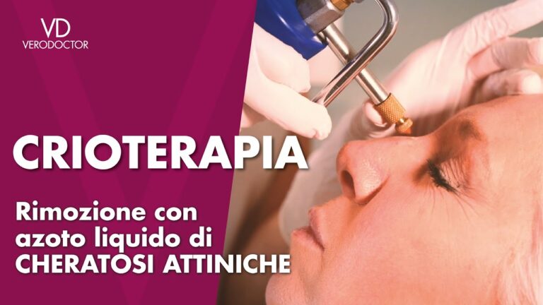 Come Trattare una Bolla Dopo la Crioterapia