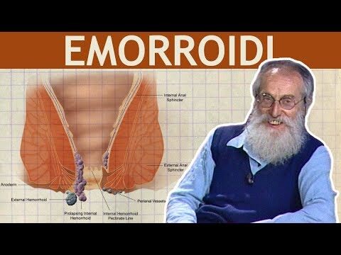 Emorroide violacea: cause, sintomi e trattamenti