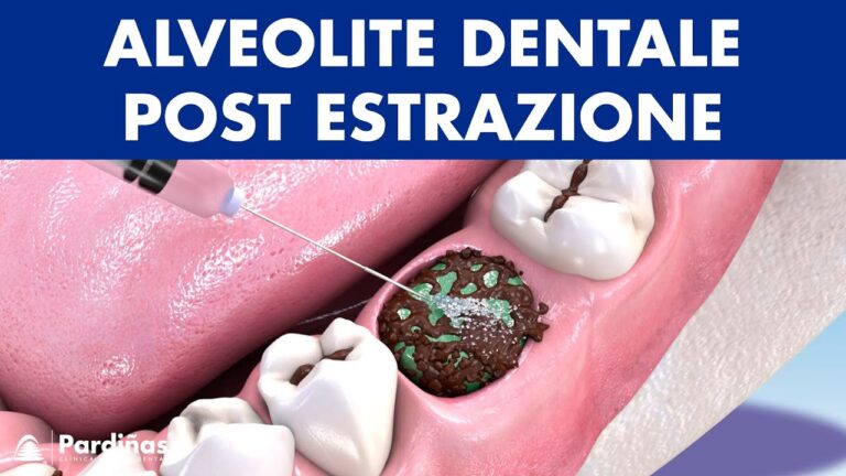 Estrazione dente devitalizzato: come gestire l'infezione