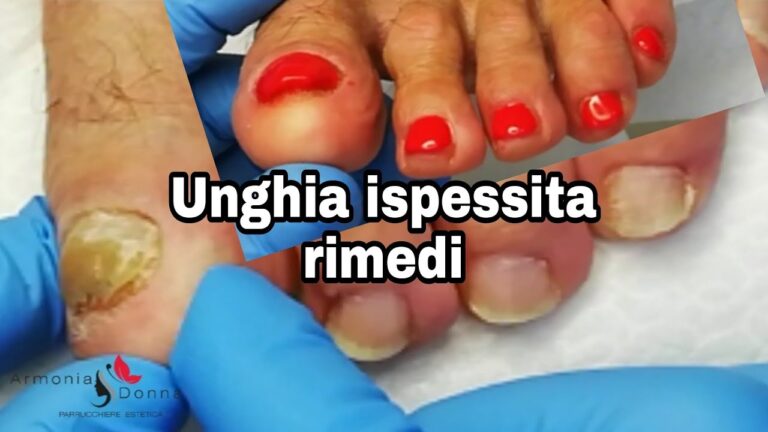 Come trattare unghia alluce ispessita