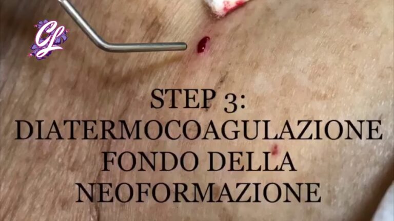 Rimozione efficace del corno cutaneo: tutto ciò che devi sapere