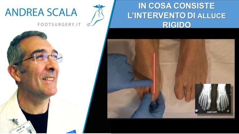 Come trattare l'alluce rigido: consigli efficaci