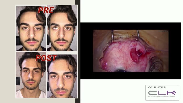 Rischi dell'intervento per il strabismo: una guida completa