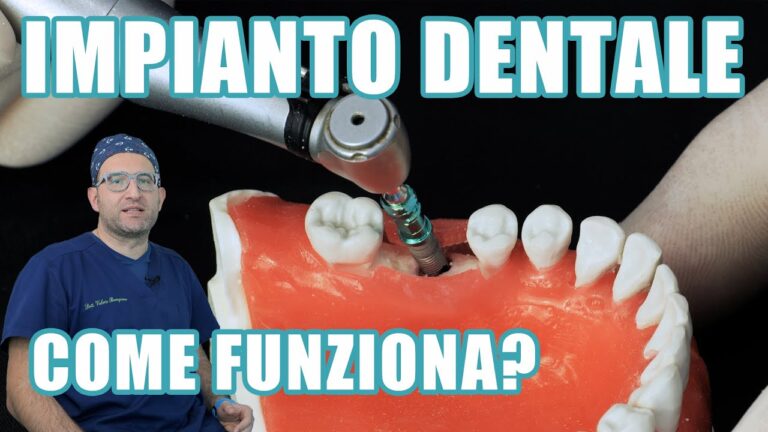 Guida pratica per l'installazione di un impianto dentale