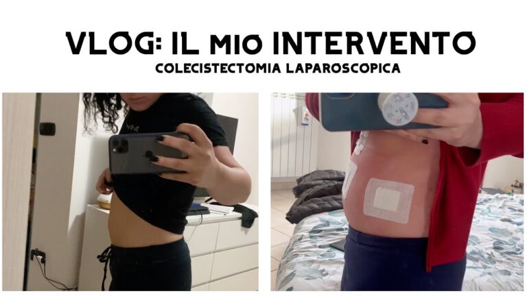 Dolori post-colecistectomia: cause e gestione a lungo termine
