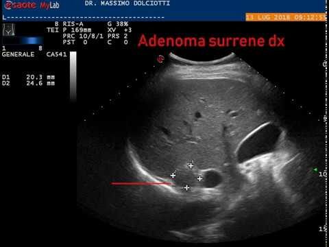 Adenoma surrenale 5 cm: cause, sintomi e trattamento