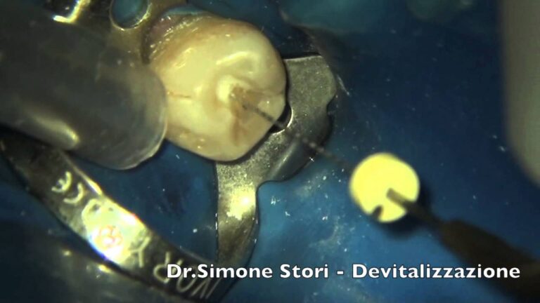 Denti devitalizzati: cause, sintomi e trattamenti