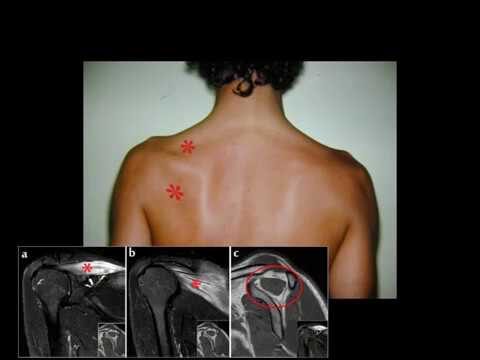 La sindrome del nervo soprascapolare: diagnosi e trattamento