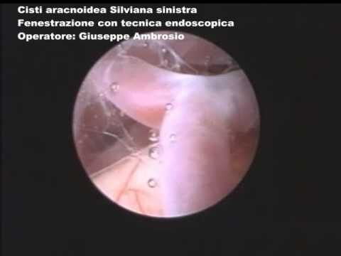 Tumore ciste aracnoidea: sintomi e trattamento