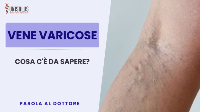 La dilatazione patologica delle vene: cause e trattamenti