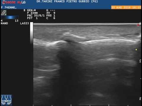 Frattura della falange della mano: diagnosi e trattamento