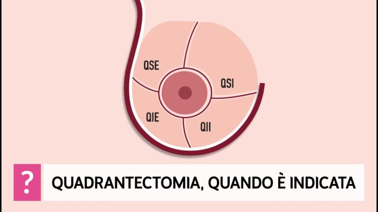 Quadrectomia con Linfonodo Sentinella Negativo: Un Approccio Ottimizzato