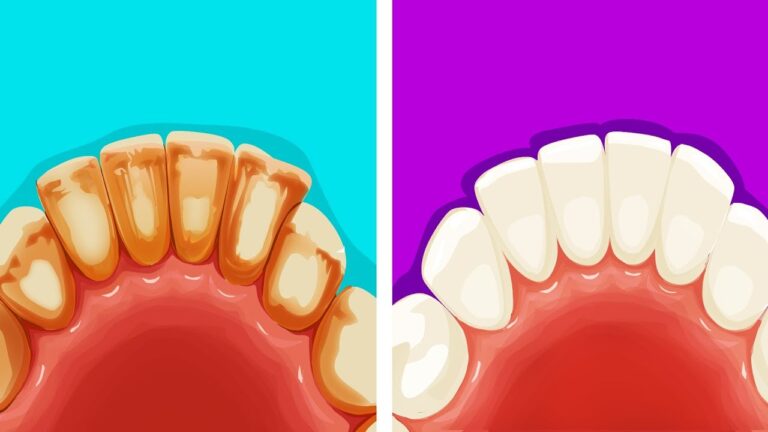 Rimedi efficaci contro la placca ai denti