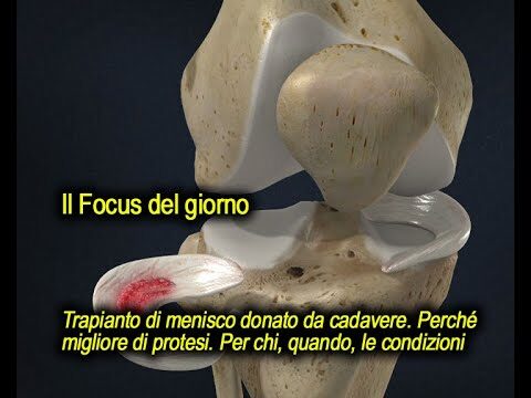 Protesi Menisco: Guida Completa all'intervento Chirurgico