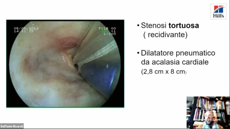 Endoscopia Esofagea: Procedure, Indicazioni e Risultati