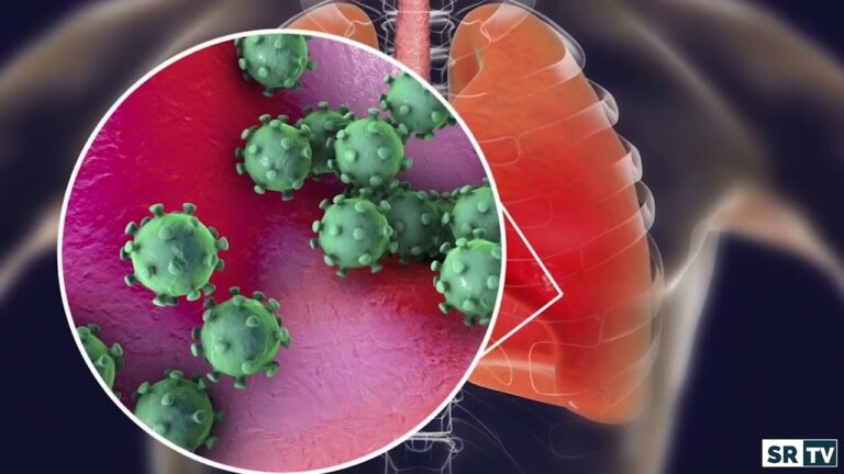Micronoduli polmonari associati a COVID: una panoramica completa
