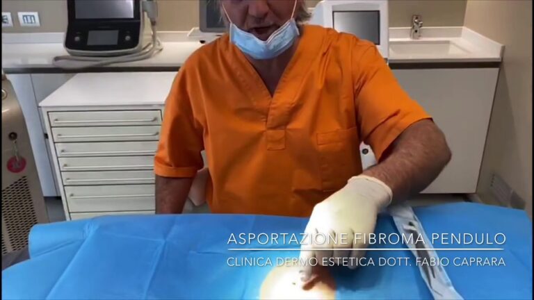 Costo della rimozione dei fibromi penduli: un'analisi ottimizzata